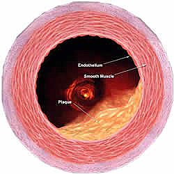 Angina,angina pain,angina troubles,heart pain,angina care,Arterial plaque,artery blockage,clogged artery,arteries,blockages,arterial disease,circulation problems,artery problems,plaque removal,plaque,chelation,chelation treatment,oral chelation,iv chelat">