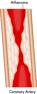 Arterial plaque,artery blockage,clogged artery,arteries,blockages,arterial disease,circulation problems,artery problems,plaque removal,plaque,chelation,chelation treatment,oral chelation,iv chelation,blood pressure problems