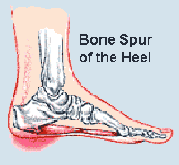 bone spurs,calcium buildup,spurs,heel spurs,foot problems,chelation,oral chelation,calcium buildup reduction,foot pain,shoulder pain