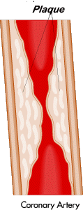 chelation,chelation treatment,chelators,liquid oral chelation,iv chelation,chelation therapy,EDTA chelation,EDTA,chelation products,blocked arteries,clogged artery,oral chelation,cleaning artery,clearing arteries,carotid artery
