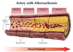 Atherosclerosis, Coronary Artery Disease,Carotid Artery Disease,Peripheral Artery Disease