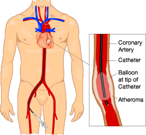 Angioplasty is One of many Possible Solution
