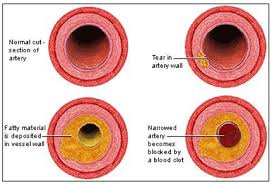 Reduce Plaque, clean arteries, liquid chelation,liquid EDTA, liquid oral chelation, chelation