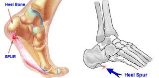 Bone Spurs,Reduce Plaque, clean arteries, liquid chelation,liquid EDTA, liquid oral chelation, chelation