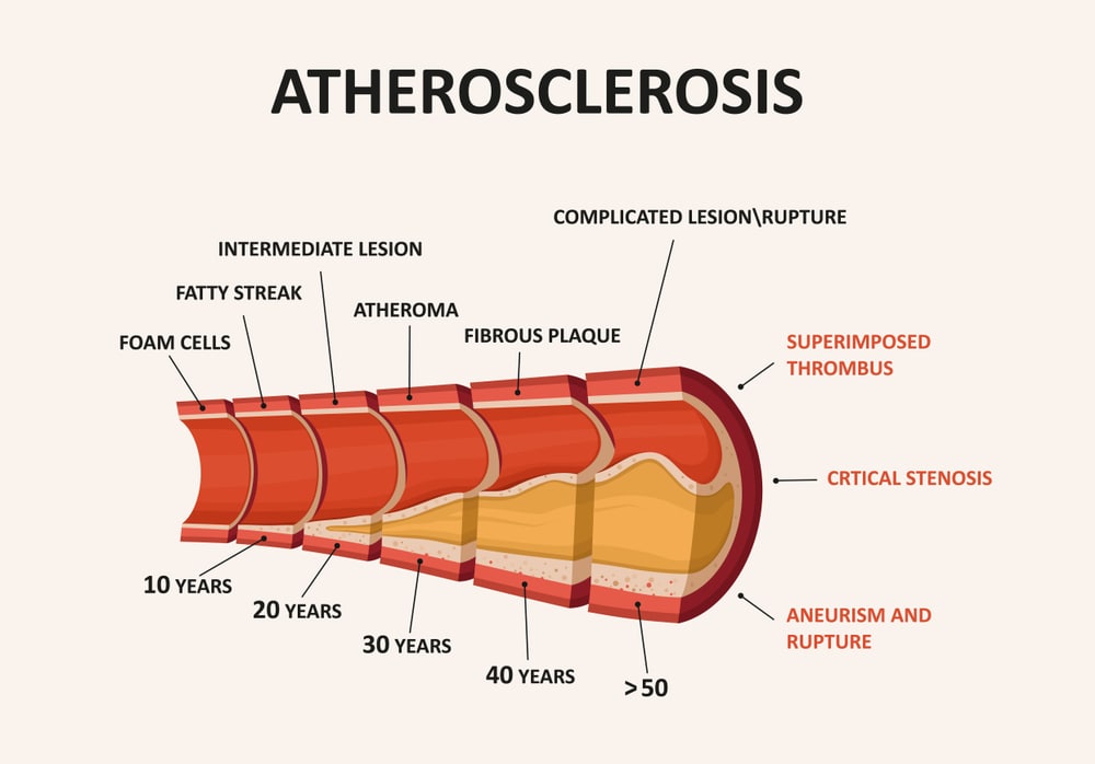Atherosclerosis, Coronary Artery Disease,Carotid Artery Disease,Peripheral Artery Disease