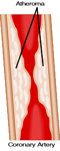 Angioprim is a safe way to reduce Arterial plaque in your arteries and veins.